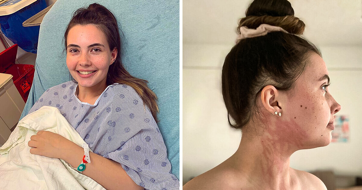 “It Is Heartbreaking”: Meet a Girl Who Is Allergic to... Water