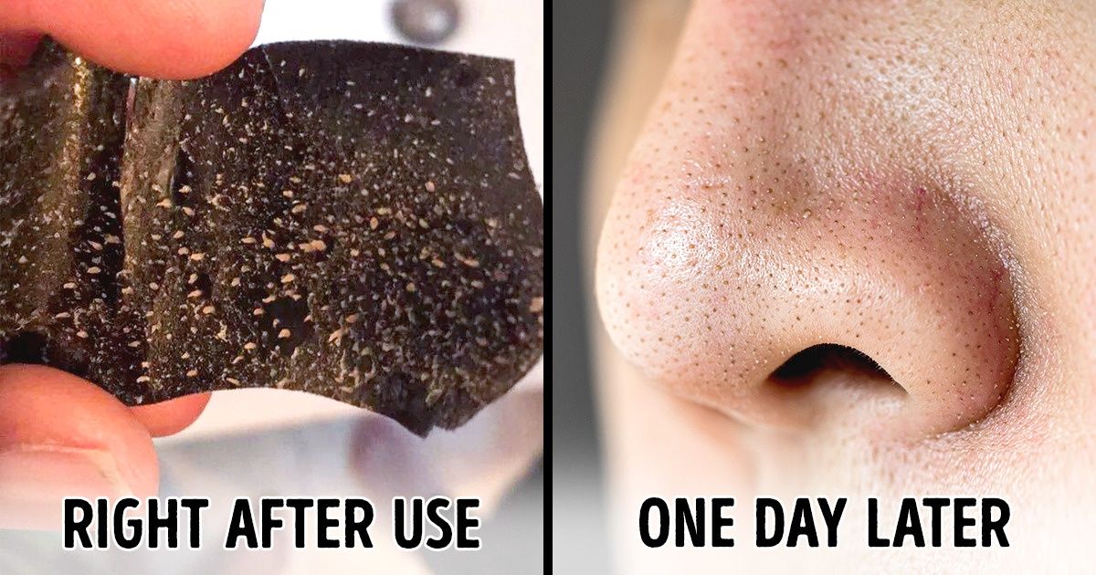 6 Things You Need to Know Before Using Pore Strips