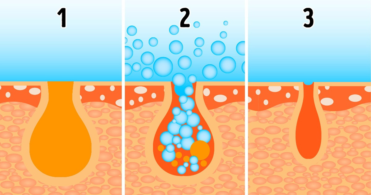 Why Large Pores Appear, and How to Get Rid of Them Without Undergoing Expensive Procedures