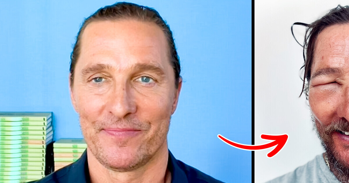 Matthew McConaughey Worries His Fans Posting a Snap of His Swollen Eye