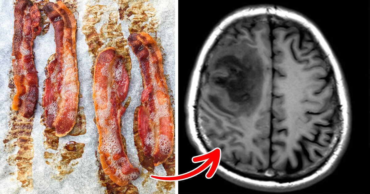 Worm Eggs Discovered in Man’s Brain After Migraine Complaints — Undercooked Bacon Was the Reason