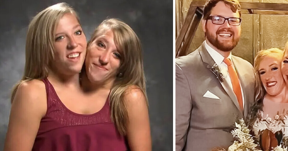 One of the Conjoined Twins Got Married, and It Sparked a Heated Discussion Online One of the Conjoined Twins Got Married, and It Sparked a Heated Discussion Online