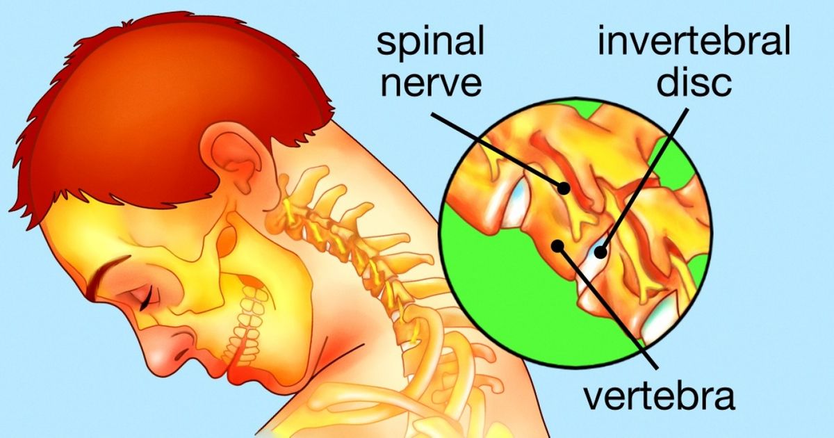9 Remedies That Can Help You Say Goodbye to Neck Pain