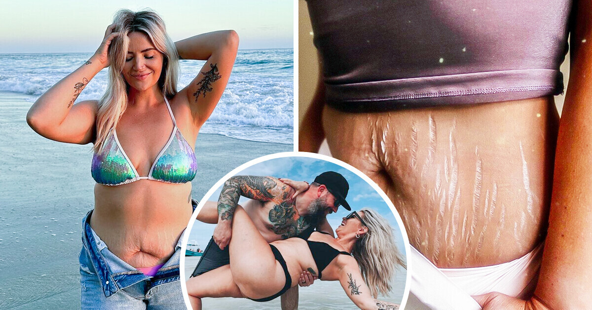 Haters Claimed Her Husband Must Be Disgusted by Her Stretch Marks — Her Epic Response Shut Them Down Haters Claimed Her Husband Must Be Disgusted by Her Stretch Marks — Her Epic Response Shut Them Down