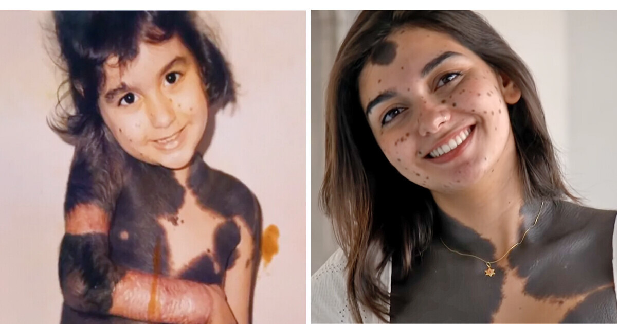 I Was Called ’Monkey’ Because of My Birthmark, but I Stopped Surgeries and Found Love I Was Called ’Monkey’ Because of My Birthmark, but I Stopped Surgeries and Found Love