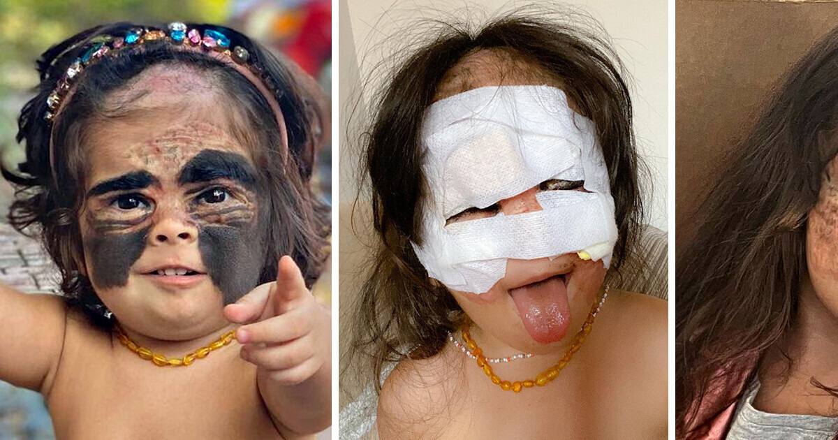 A Little Girl Was Called a ’Monster’ Because of Her Birthmark, Until Her Mom Brought Back Her Sweet Smile A Little Girl Was Called a ’Monster’ Because of Her Birthmark, Until Her Mom Brought Back Her Sweet Smile