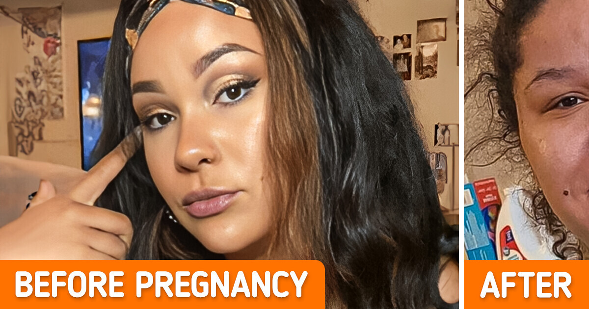 A Woman Discovers Pregnancy Nose That Completely Reshaped Her Face