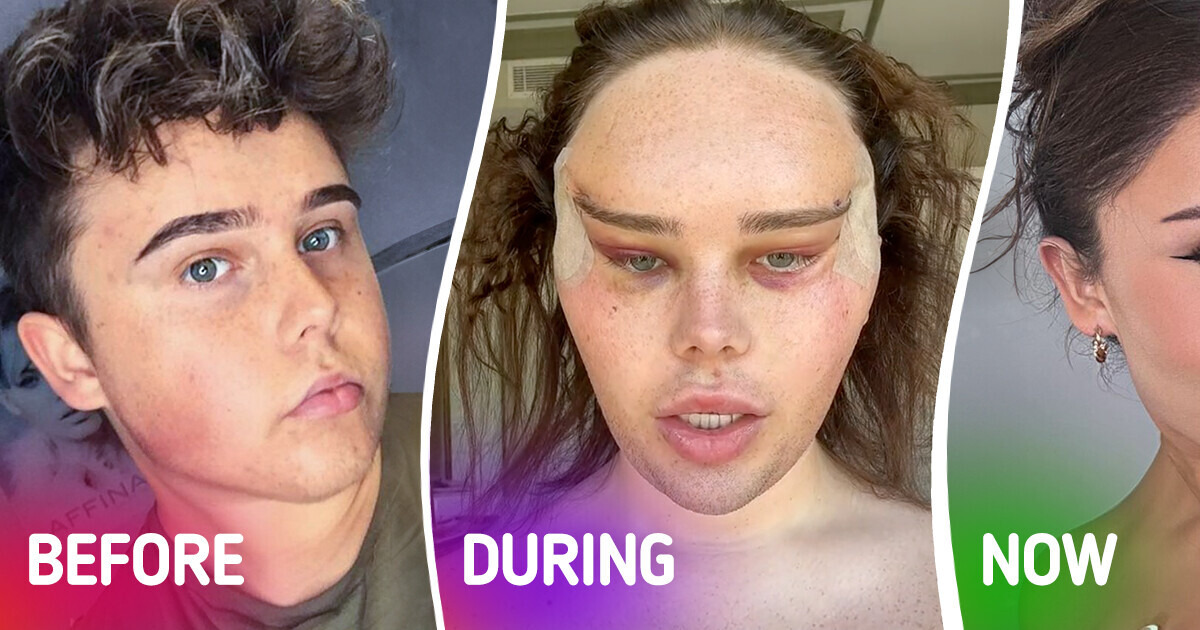 Trans Influencer Reveals Crazy Results of “Foxy” Eye Plastic Surgery Trans Influencer Reveals Crazy Results of “Foxy” Eye Plastic Surgery