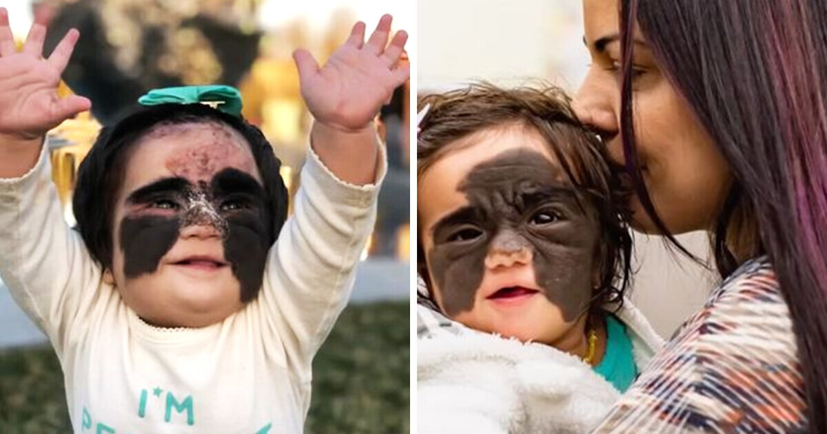 A Little Girl Was Called “Monster” for Her “Batman” Face, Now She Looks Like a Disney Princess A Little Girl Was Called “Monster” for Her “Batman” Face, Now She Looks Like a Disney Princess