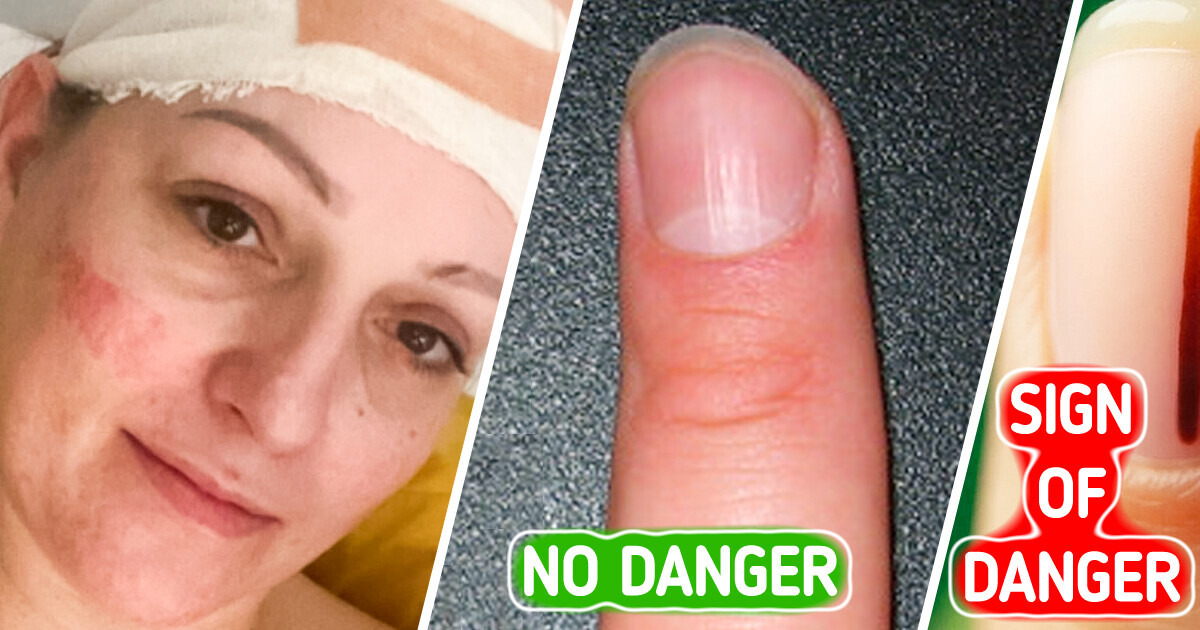 A Mom’s Subtle Change of a Fingernail Turned Out to Be the Sign of Terminal Cancer Spreading to Her Brain A Mom’s Subtle Change of a Fingernail Turned Out to Be the Sign of Terminal Cancer Spreading to Her Brain