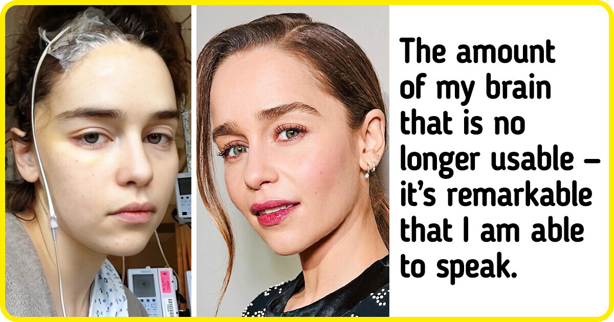 Emilia Clarke Honestly Shares Her Story About Losing a Part of Her Brain and Experiencing Awful Pain Emilia Clarke Honestly Shares Her Story About Losing a Part of Her Brain and Experiencing Awful Pain