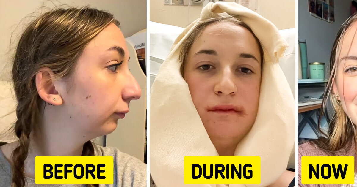 Young Woman Reveals Dramatic Results of Her Jaw Surgery, Leaving People Stunned Young Woman Reveals Dramatic Results of Her Jaw Surgery, Leaving People Stunned