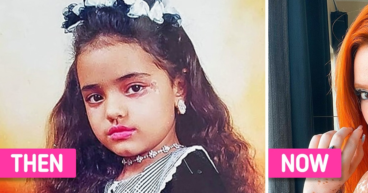 Meet Barbarhat, a Model With Vitiligo Who Loves Her Dappled Skin and Shines Brighter Than the Sun