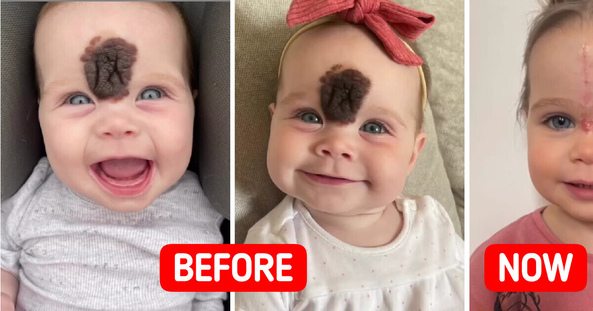 ’’We Got Stares’’, Parents Choose to Remove Baby Girl’s Rare Birthmark to Avoid Rude Reactions ’’We Got Stares’’, Parents Choose to Remove Baby Girl’s Rare Birthmark to Avoid Rude Reactions
