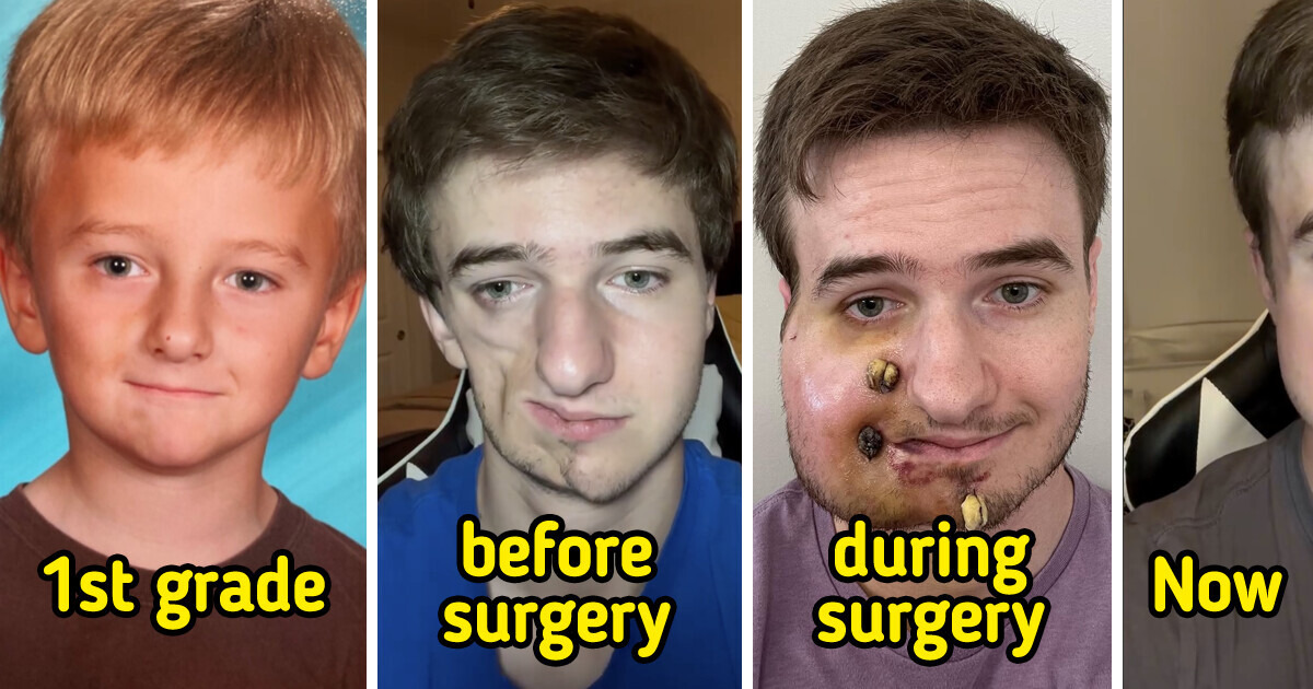 Meet Lukas: the Real Story of Parry-Romberg Syndrome and How He Looks Today Meet Lukas: the Real Story of Parry-Romberg Syndrome and How He Looks Today