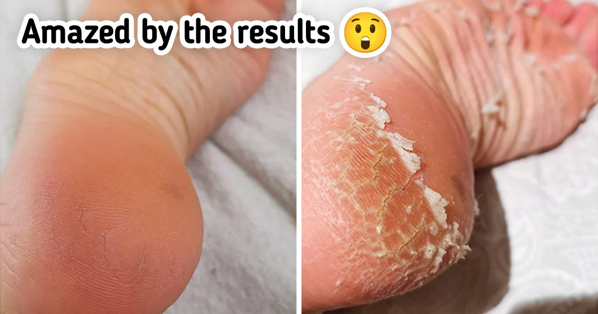Put Your Best Foot Forward: The Top 10 Solutions for Softer, Smoother Feet