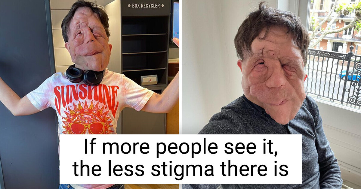 How a Man With a Rare Disease Survived Childhood Trauma and Became a Hollywood Actor