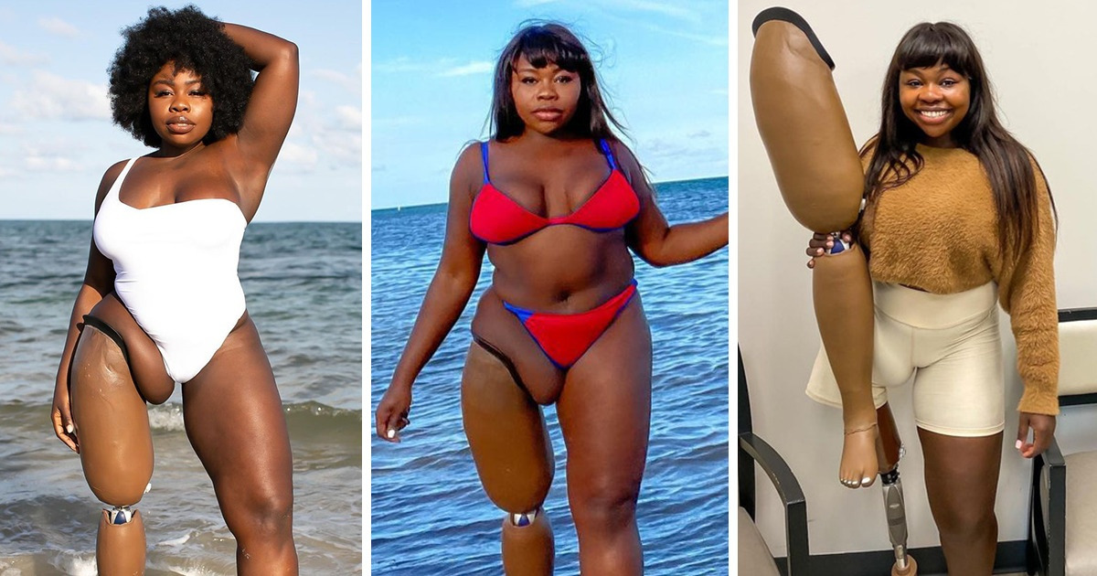 Inspiring Amputee Model Posts Bikini Snaps Showing Off Her