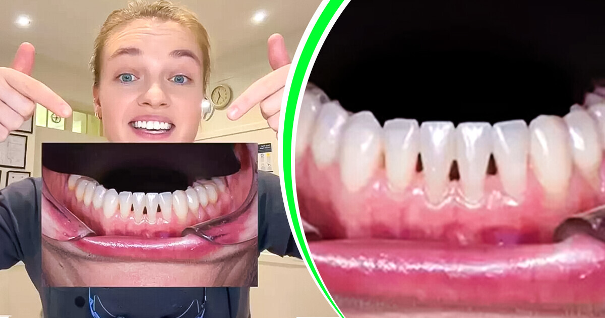 A Dentist Explains What It Actually Means If You Have “Black Triangles” Between Your Teeth A Dentist Explains What It Actually Means If You Have “Black Triangles” Between Your Teeth