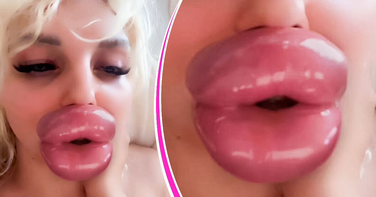 “I’m More Lips Than Human”, a Woman Struggles to Eat Because of Her Big Lips, but She Doesn’t Stop “I’m More Lips Than Human”, a Woman Struggles to Eat Because of Her Big Lips, but She Doesn’t Stop