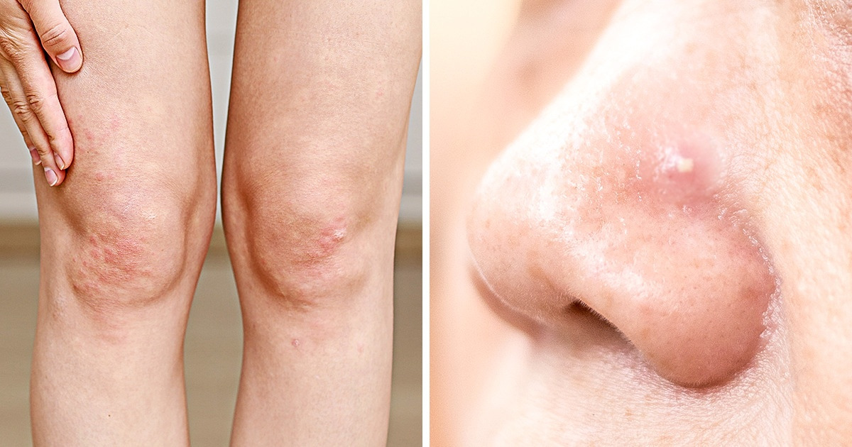 What the Acne on 8 Body Parts Is Trying to Tell You About Your Lifestyle Habits What the Acne on 8 Body Parts Is Trying to Tell You About Your Lifestyle Habits