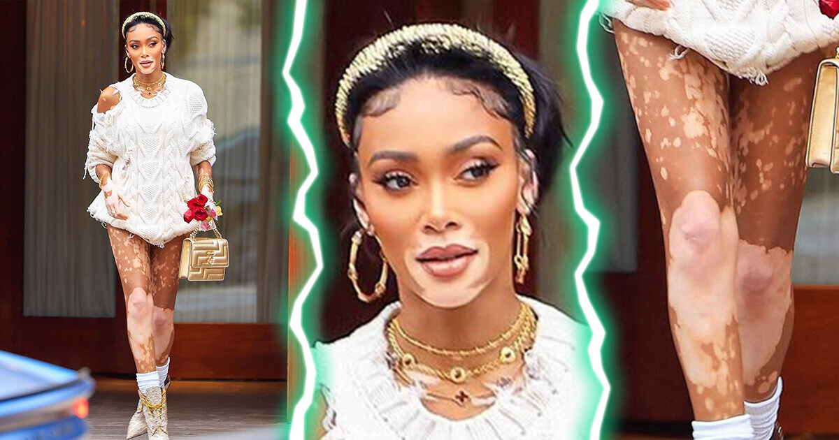 From “Cow” to Cover Supermodel, a Girl Was Heavily Teased Because of Her Vitiligo but Made It to the Top in Life From “Cow” to Cover Supermodel, a Girl Was Heavily Teased Because of Her Vitiligo but Made It to the Top in Life