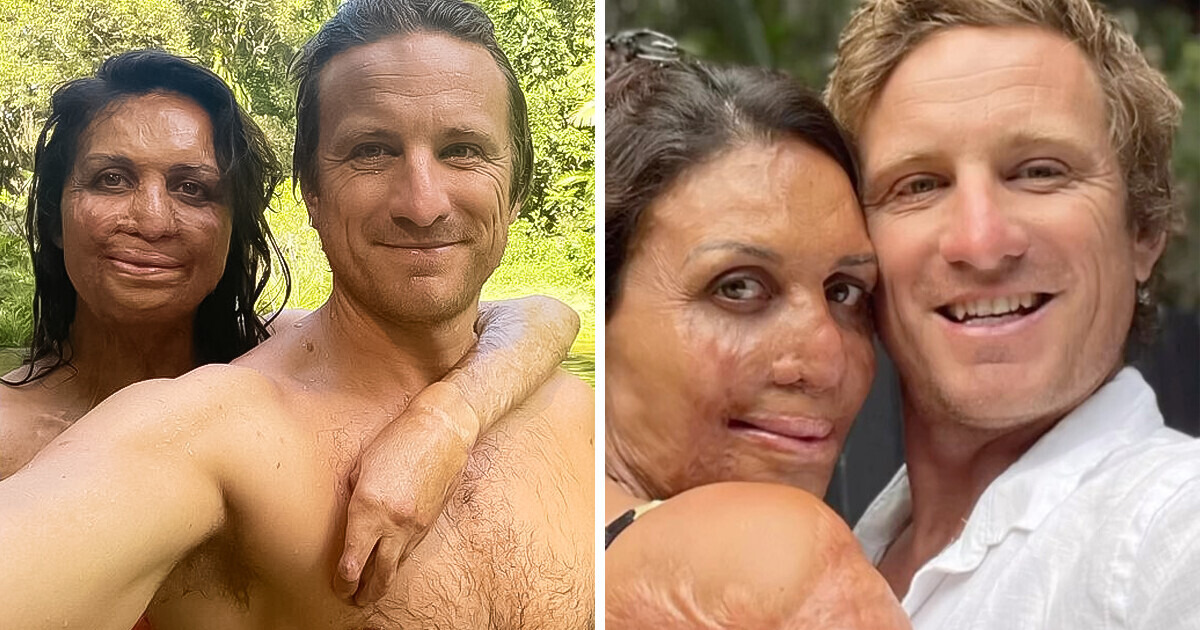 Man Marries His Loved One Despite Her Being Severely Disfigured After a Severe Accident (New Pics)