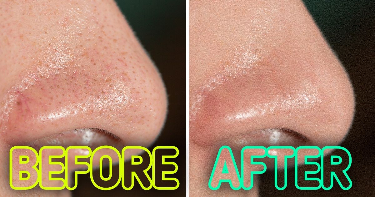 10 Tips From Dermatologists That Can Help You to Tighten Large Pores