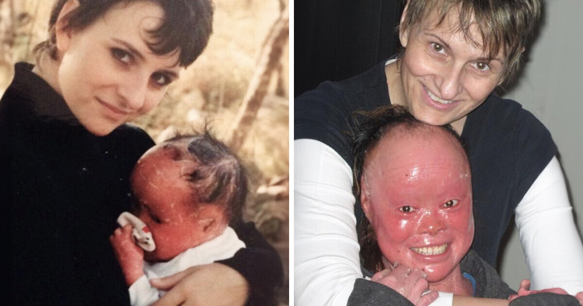 A Couple Adopts a Red-Skin Girl With Slight Chances of Surviving, and Raises Her Into a Champion A Couple Adopts a Red-Skin Girl With Slight Chances of Surviving, and Raises Her Into a Champion