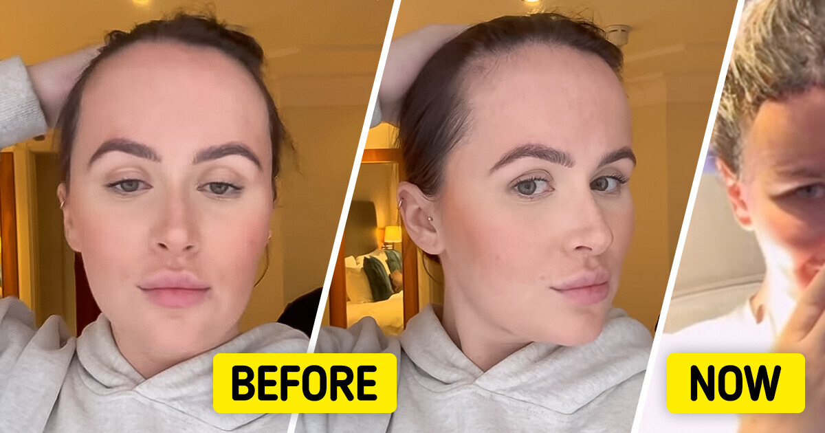 A Woman Decides to Undergo Forehead Reduction Surgery After Being Shamed for It