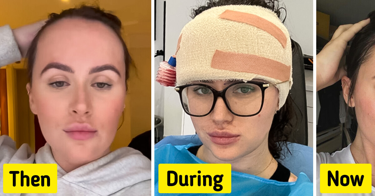 A Woman Who Was Shamed for the Size of Her Forehead Gets Plastic Surgery to Reduce It A Woman Who Was Shamed for the Size of Her Forehead Gets Plastic Surgery to Reduce It