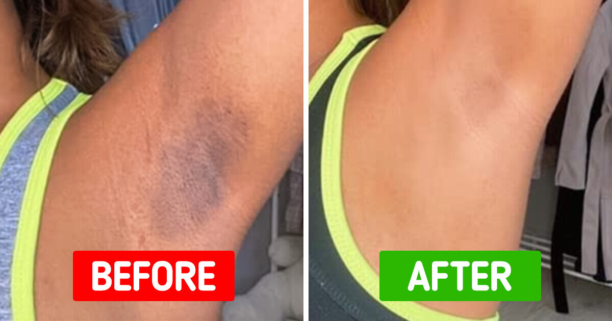 8 Amazon Products That’ll Help You Kiss Your Dark Spots Goodbye