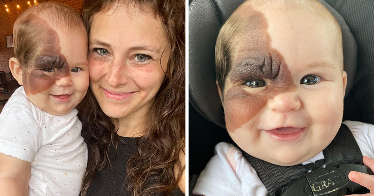 Little Winry Was Born With a Rare Birthmark, and Her Mom Shows How Beautiful Her Daughter Is Little Winry Was Born With a Rare Birthmark, and Her Mom Shows How Beautiful Her Daughter Is