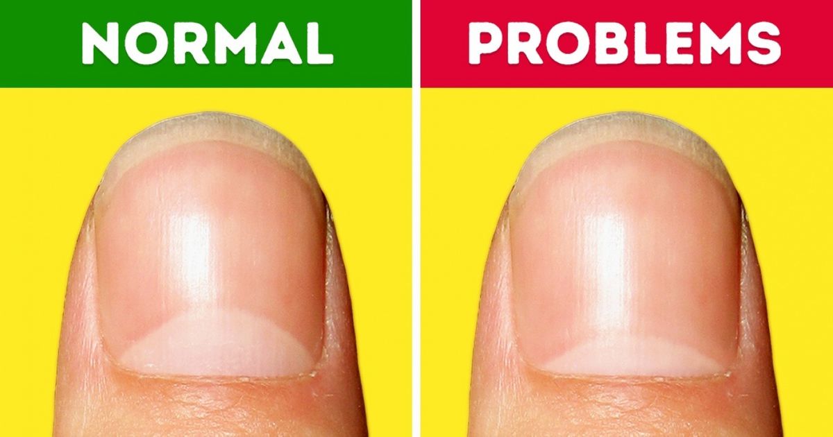 13 Health Problems The Moons On Your Nails Warn You About