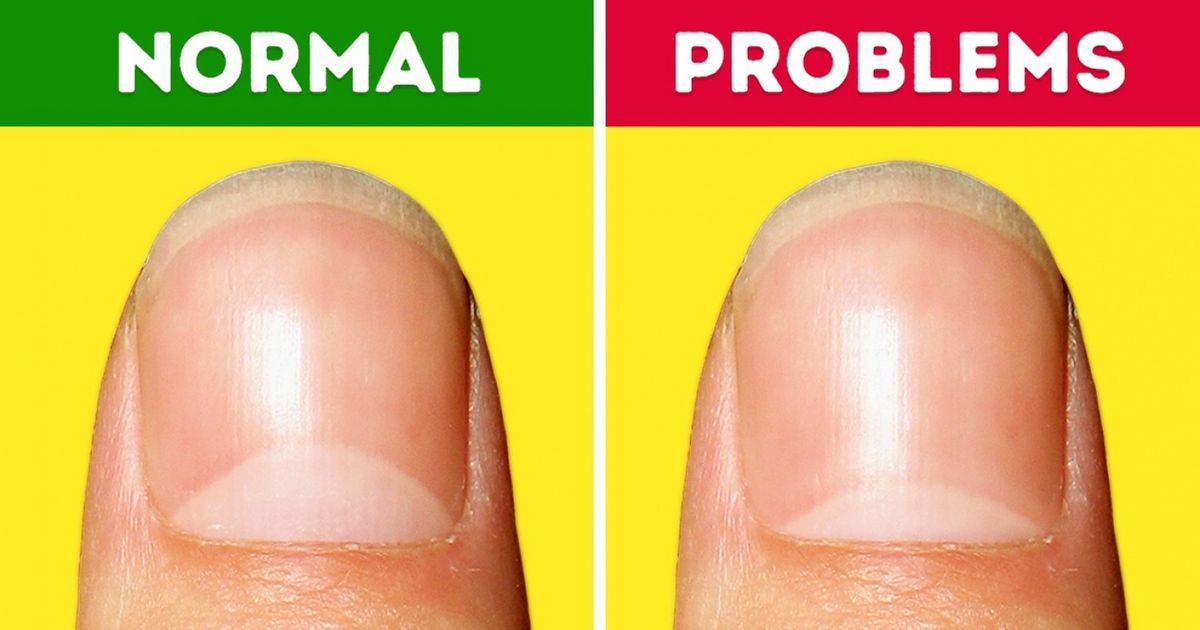 13-health-problems-the-moons-on-your-nails-warn-you-about