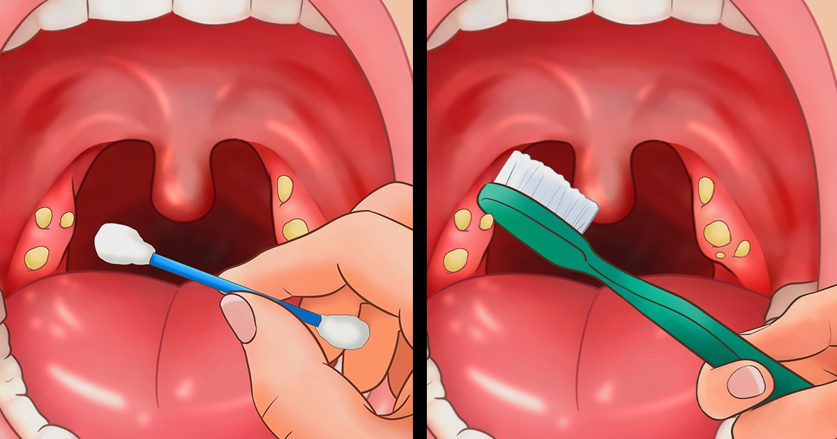 What can i use to get rid of tonsil stones An Ent Tells You How To Get Rid Of Tonsil Stones