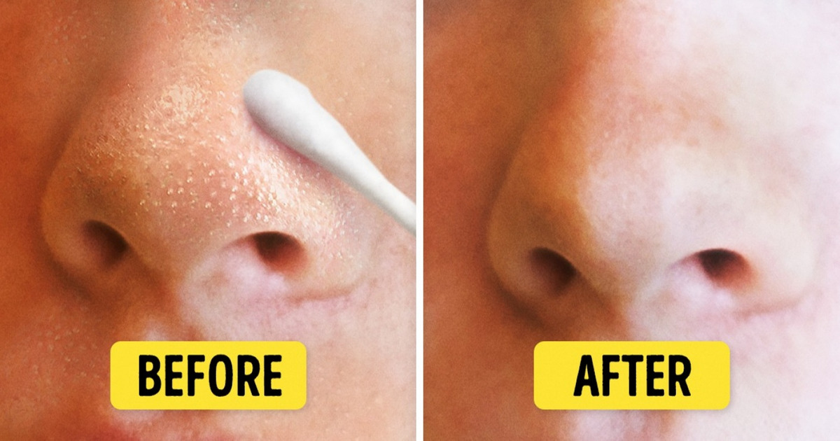 8 Natural Ways To Get Rid Of Blackheads And Whiteheads Fast