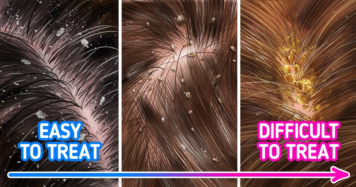 Why Dandruff Appears and How to Effectively Deal With It Why Dandruff Appears and How to Effectively Deal With It