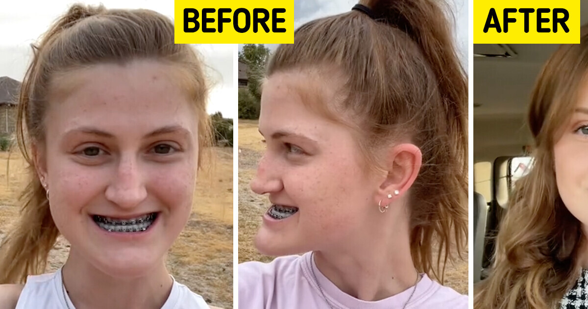 Young Woman Documents Her Double Jaw Surgery, and Leaves Everyone Stunned With the Results Young Woman Documents Her Double Jaw Surgery, and Leaves Everyone Stunned With the Results