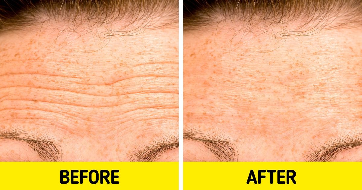 5 Natural Remedies to Make Forehead Lines Less Visible / Bright Side