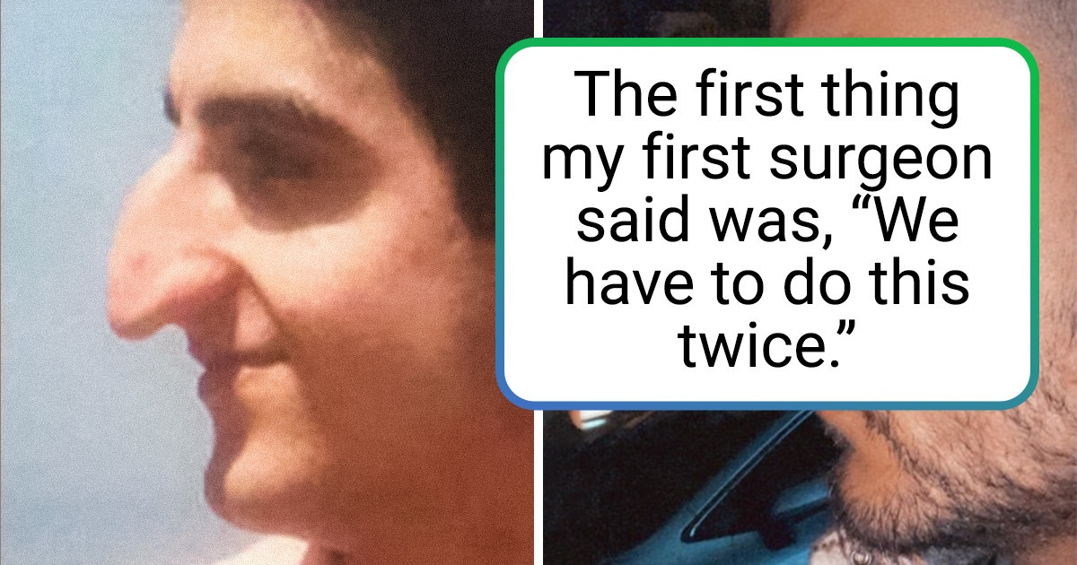 18 People Who Opted for Plastic Surgery to Change Their Look and Improve Their Self-Esteem 18 People Who Opted for Plastic Surgery to Change Their Look and Improve Their Self-Esteem