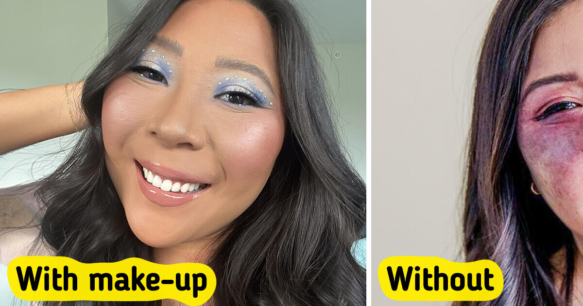 A Woman With a Face Birthmark Shares What Is Like to Always Have People Starring at Her A Woman With a Face Birthmark Shares What Is Like to Always Have People Starring at Her