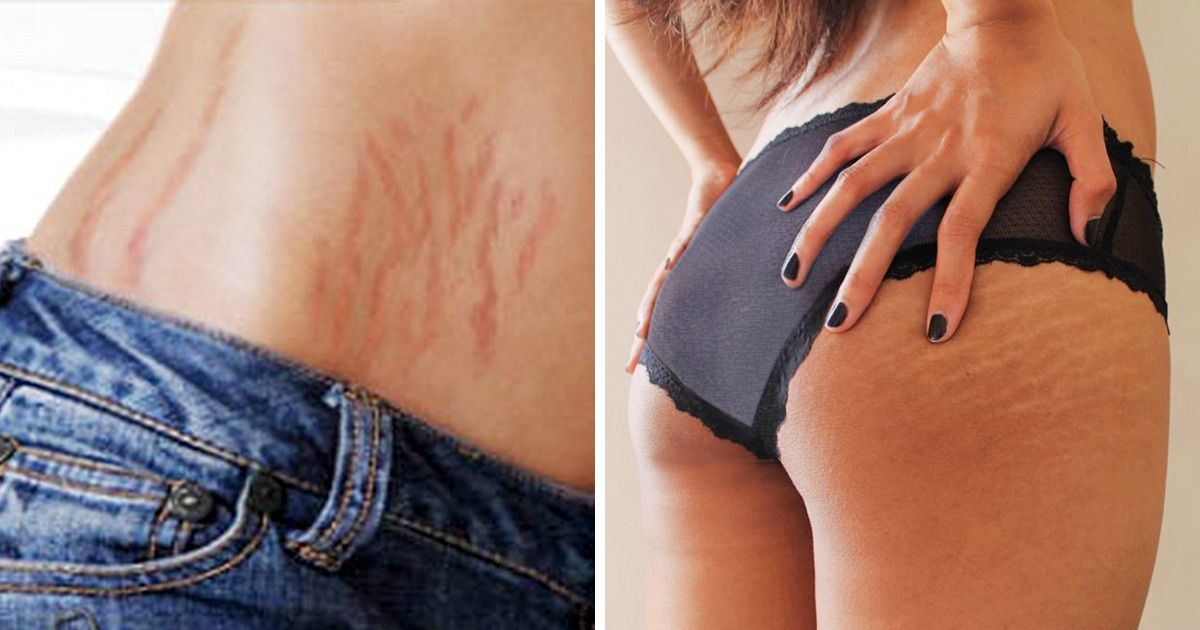 People Are Now Getting Skin Colored Tattoos To Camouflage Their Stretch Mar...