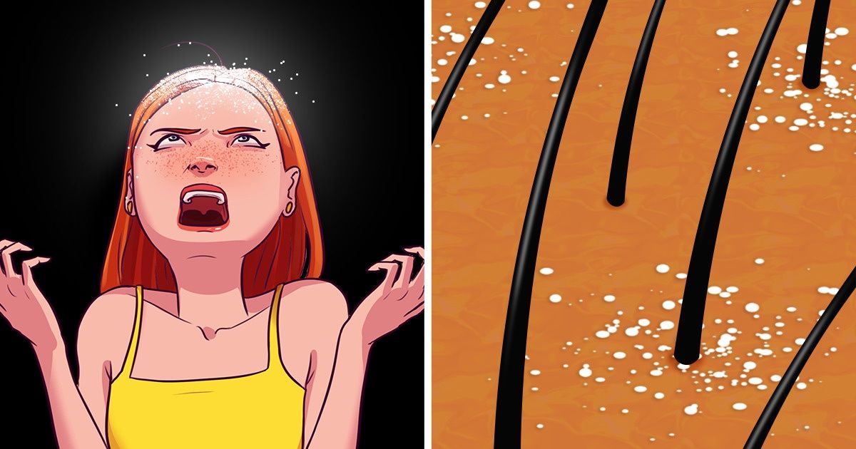 13 Sneaky Habits That Are Giving You Dandruff