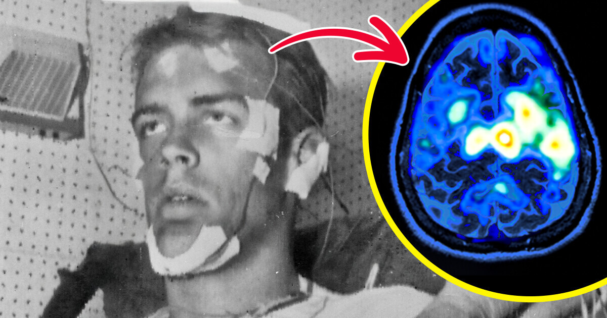 A Man, Who Didn’t Sleep for a Record 264 Hours as an Experiment, Suffered Crippling Long-Term Effect