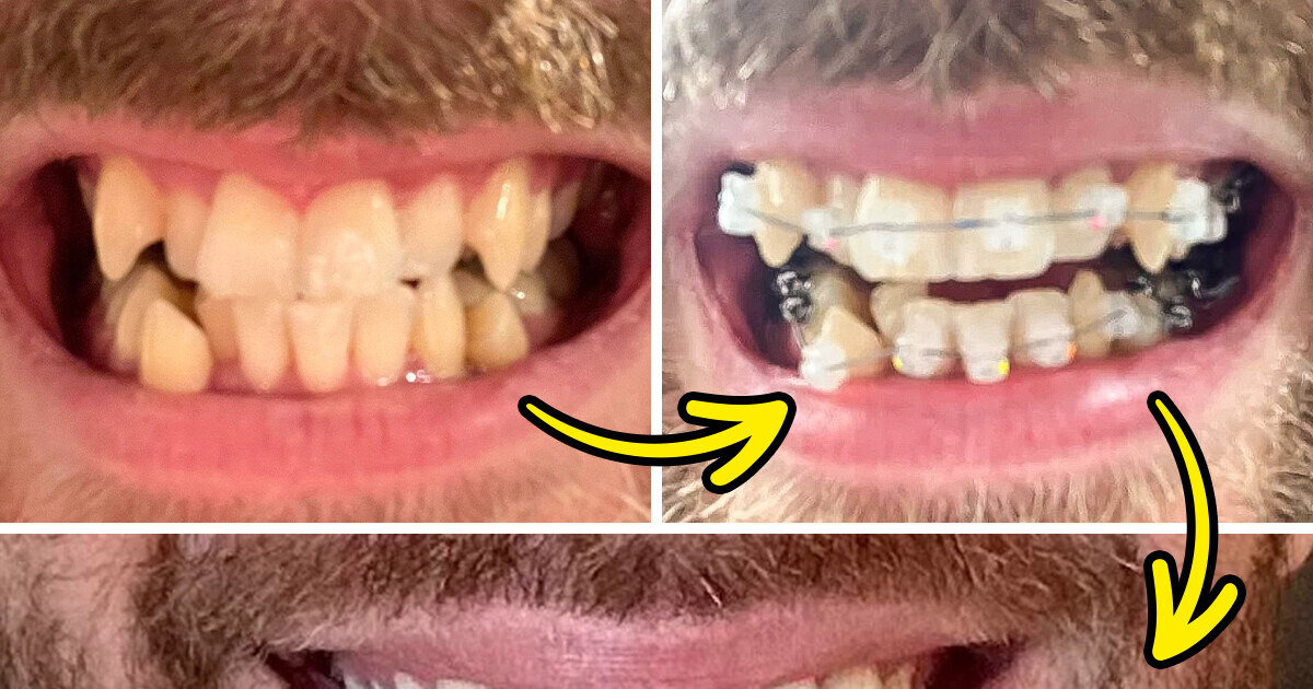 15 People Who Transformed Their Lives by Taking Care of Their Teeth