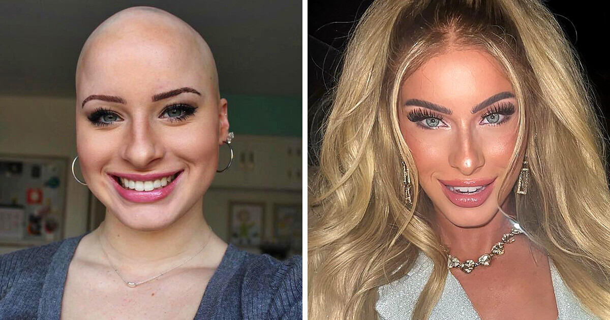A Girl Who Suffered Greatly From Alopecia Now Makes Profit Out of Her Condition A Girl Who Suffered Greatly From Alopecia Now Makes Profit Out of Her Condition