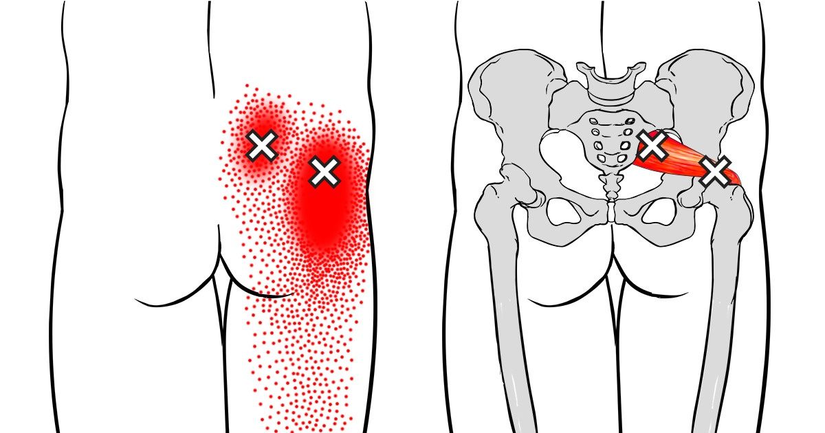 Sciatic Nerve Pain Relief, Treatment Therapy, Causes & Symptoms