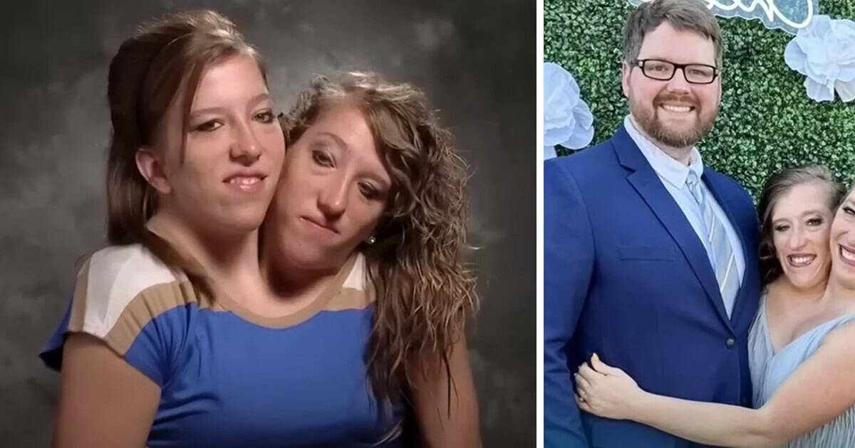 One-Half of The Conjoined Twins Got Married, and It Causes a Stir ...