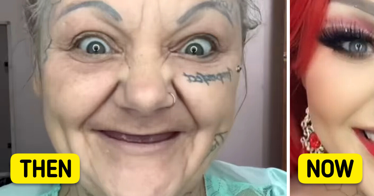 A Woman Has All of Her Teeth Removed and Shares Her Shocking Transformation A Woman Has All of Her Teeth Removed and Shares Her Shocking Transformation